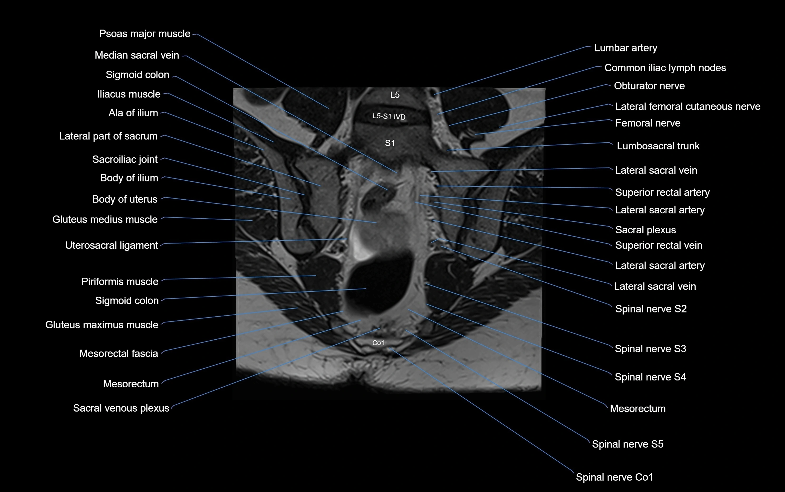 MRI sacroiliac joint coronal cross sectional anatomy  radiology  image-img-00001-00014.webp
